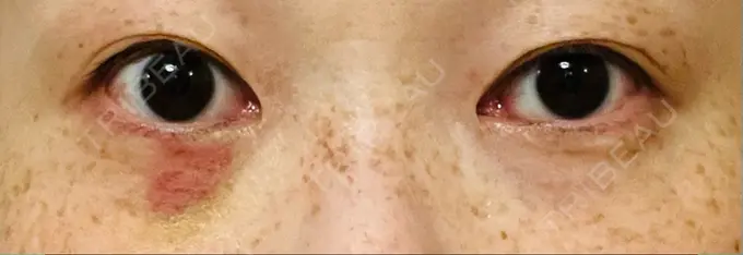 スネコス TCB東京中央美容外科 仙台駅前院 DAY 4 メイン用