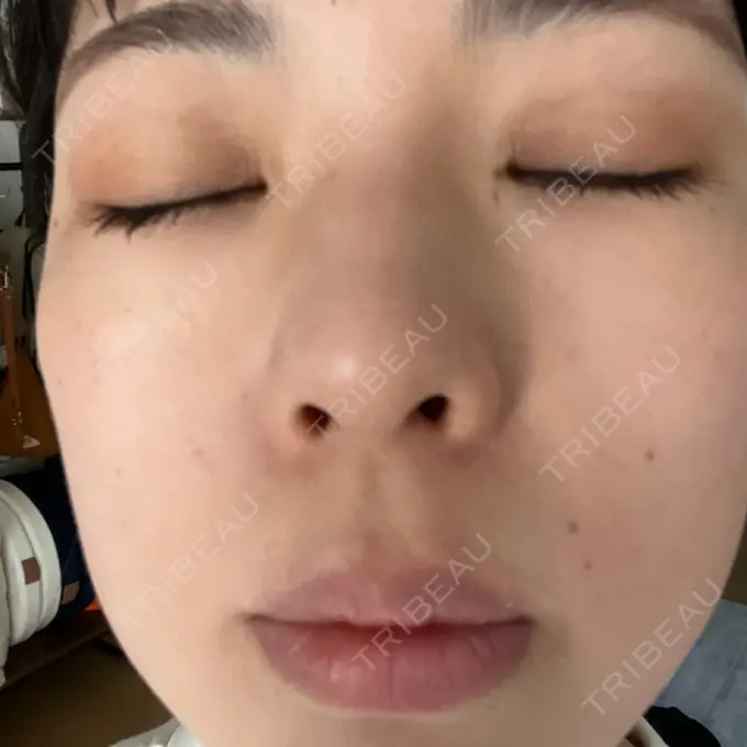 エレクトロポレーション / ピーリング（ハリ・ツヤ） ライズワン美容皮膚科クリニック DAY 2 メイン用