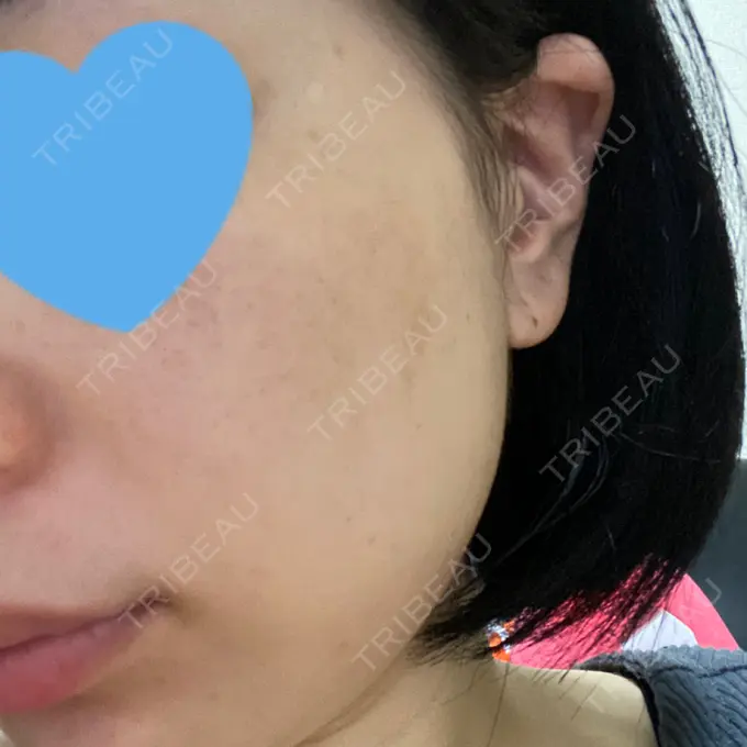 エレクトロポレーション / ピコスポット アモーレクリニック 名古屋院 DAY 9 メイン用