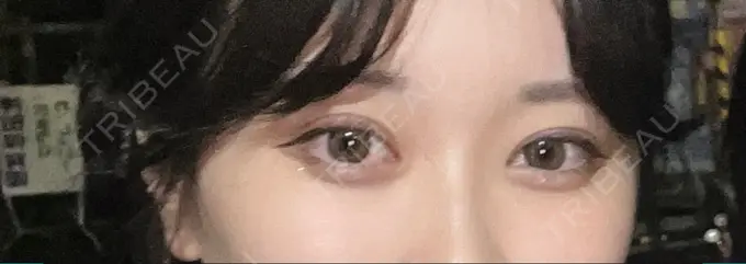 二重埋没 yuzawa clinic DAY 2 メイン用