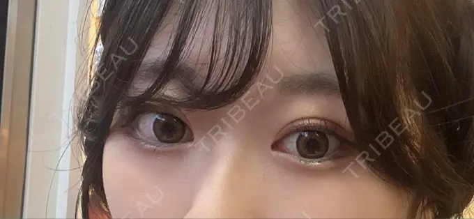 二重埋没 yuzawa clinic DAY 2 メイン用