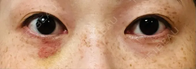 スネコス TCB東京中央美容外科 仙台駅前院 DAY 5 メイン用