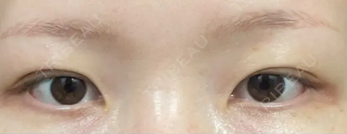 二重埋没 / ボトックス（エラ・小顔） 日本ウェルネス再生クリニック DAY 5 メイン用