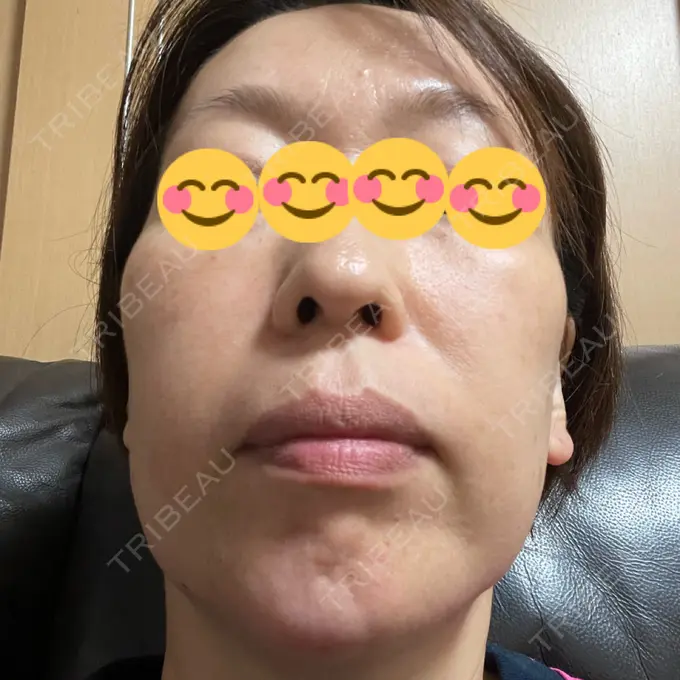 イオン導入 / ルメッカ ルラ美容クリニック 大宮院 / ルラスキンクリニック 大宮院 AFTER メイン用