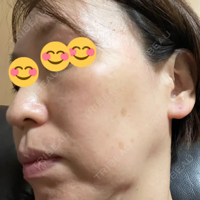 イオン導入 / ルメッカ ルラ美容クリニック 大宮院 / ルラスキンクリニック 大宮院 DAY 12 メイン用