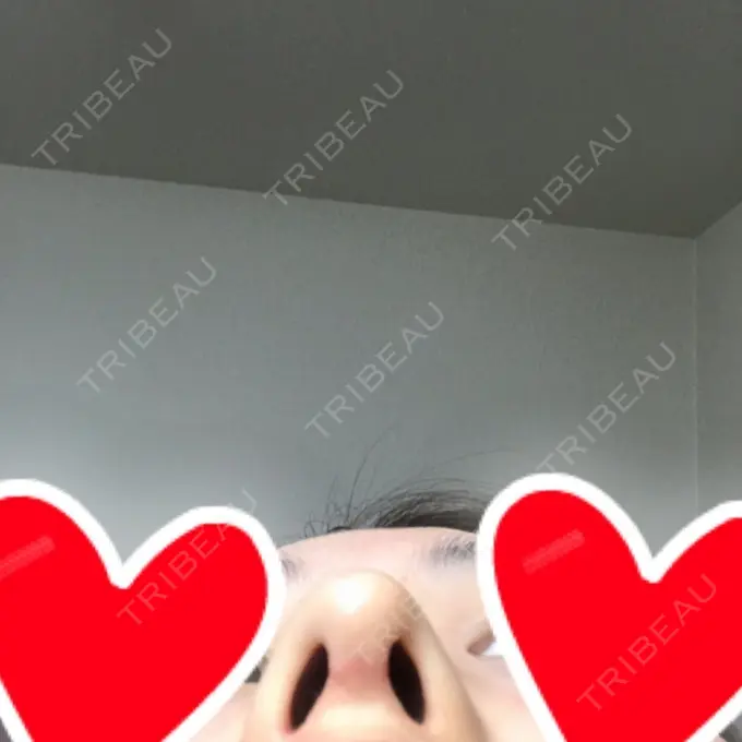 隆鼻術 / 鼻中隔延長（切開） / 軟骨移植 / 鼻修正 / 鼻孔縁下降 加藤クリニック 麻布東京院 DAY 29 メイン用