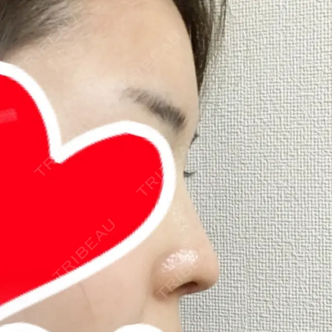 隆鼻術 / 鼻中隔延長（切開） / 軟骨移植 / 鼻修正 / 鼻孔縁下降 加藤クリニック 麻布東京院 DAY 29 メイン用