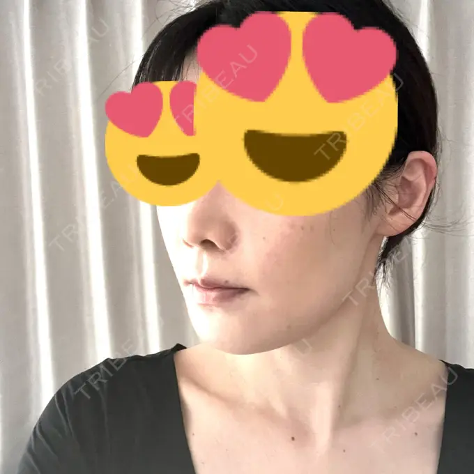 セットバック カトレア歯科・美容クリニック DAY 14 メイン用