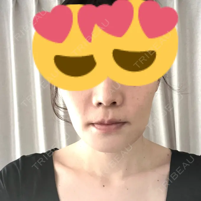 セットバック カトレア歯科・美容クリニック DAY 14 メイン用