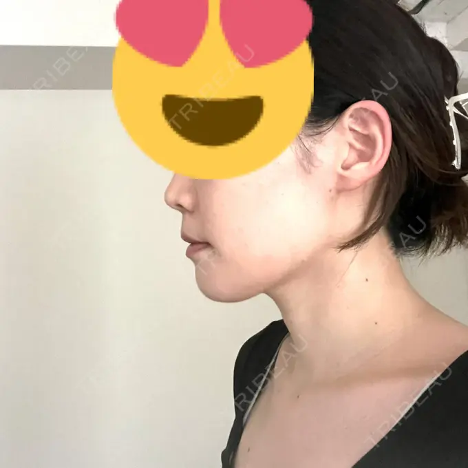 セットバック カトレア歯科・美容クリニック DAY 14 メイン用