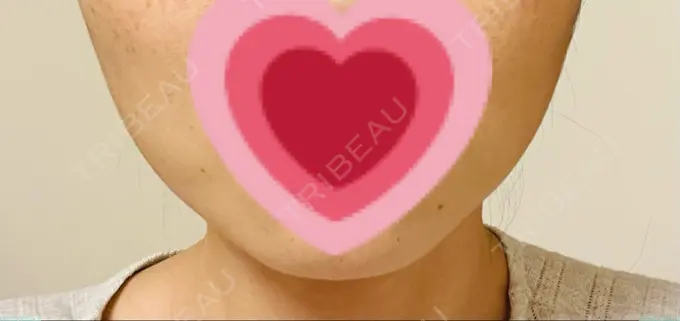 ボトックス（エラ・小顔） TCB東京中央美容外科 仙台駅前院 DAY 6 メイン用