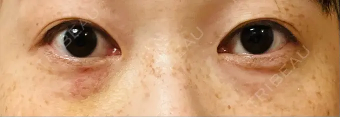 スネコス TCB東京中央美容外科 仙台駅前院 DAY 6 メイン用