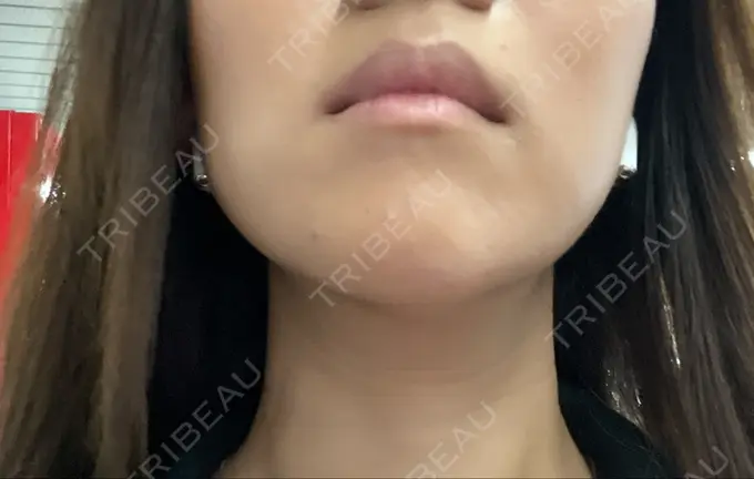 脂肪溶解注射（顔） ルラ美容クリニック 神戸院 DAY 0 メイン用