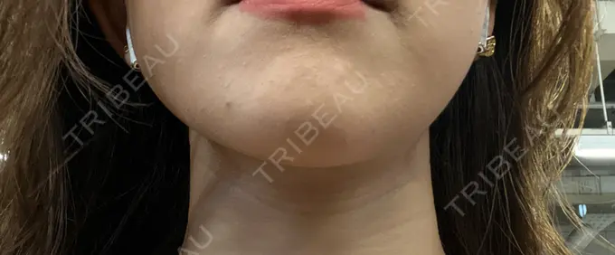 脂肪溶解注射（顔） ルラ美容クリニック 神戸院 DAY 1 メイン用