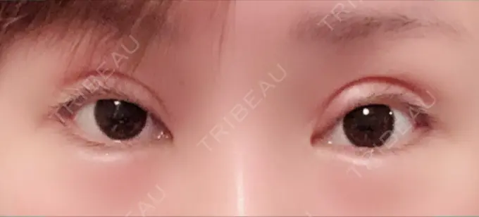 二重切開 / 眼瞼下垂（切開） / 目尻切開 / タレ目形成・グラマラスライン（切開） / 前額リフト レアート整形外科 DAY 14 メイン用