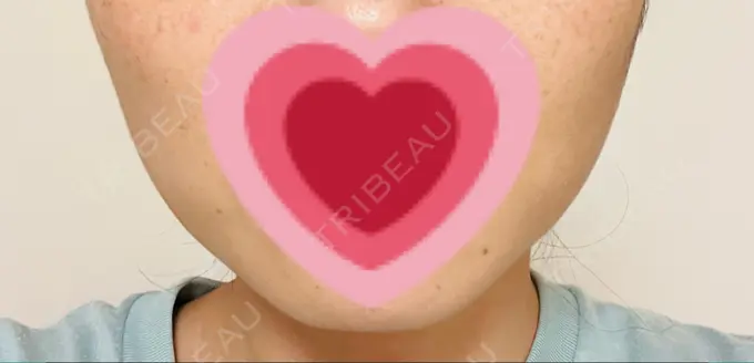 ボトックス（エラ・小顔） TCB東京中央美容外科 仙台駅前院 DAY 7 メイン用