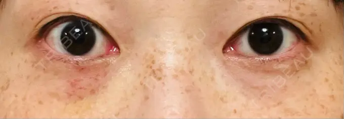 スネコス TCB東京中央美容外科 仙台駅前院 DAY 7 メイン用