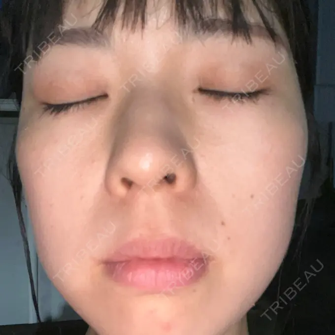 エレクトロポレーション / ピーリング（ハリ・ツヤ） ライズワン美容皮膚科クリニック AFTER メイン用