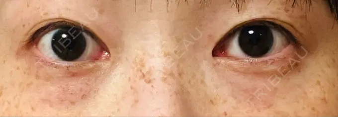 スネコス TCB東京中央美容外科 仙台駅前院 DAY 9 メイン用