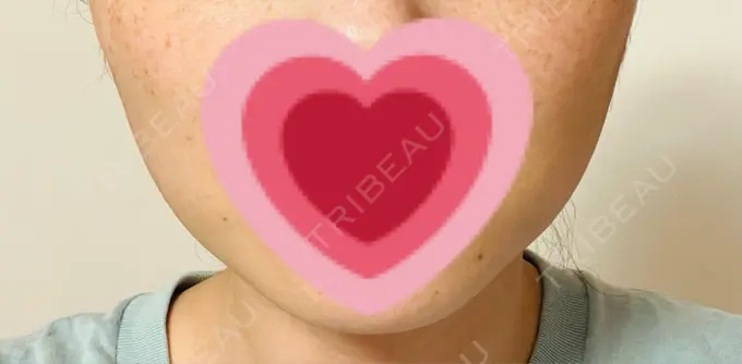 ボトックス（エラ・小顔） TCB東京中央美容外科 仙台駅前院 DAY 9 メイン用