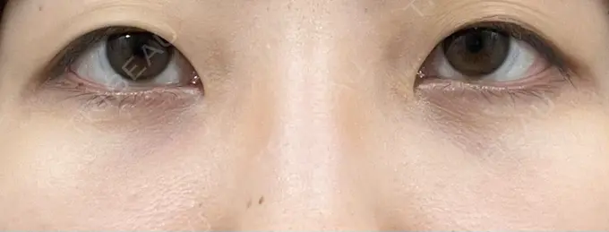 クマ治療 / 下まぶたの脂肪取り 吉井クリニック DAY 10 メイン用