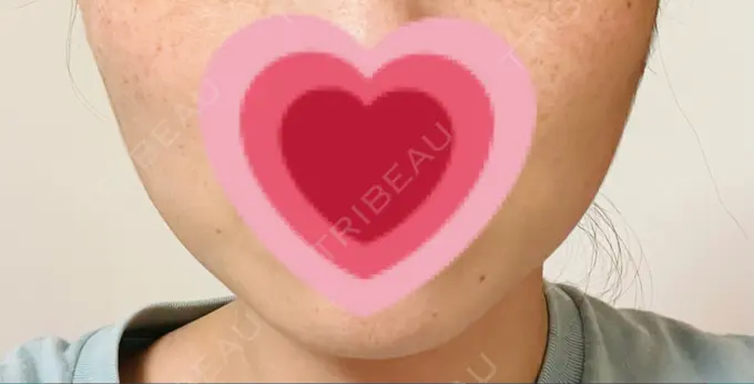 ボトックス（エラ・小顔） TCB東京中央美容外科 仙台駅前院 DAY 10 メイン用