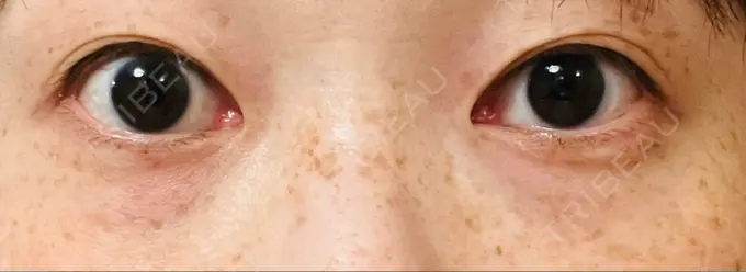 スネコス TCB東京中央美容外科 仙台駅前院 DAY 10 メイン用