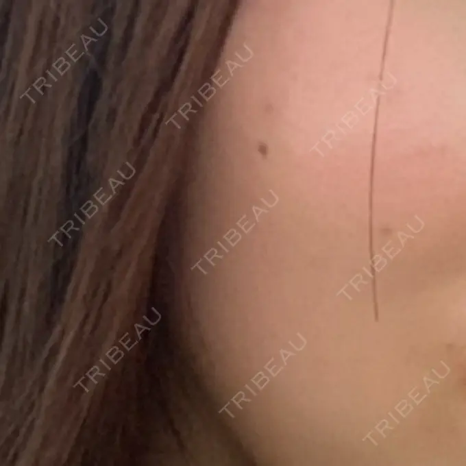 ボトックス（エラ・小顔） メディカルアルファクリニック AFTER メイン用