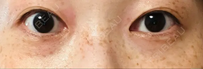 スネコス TCB東京中央美容外科 仙台駅前院 DAY 11 メイン用