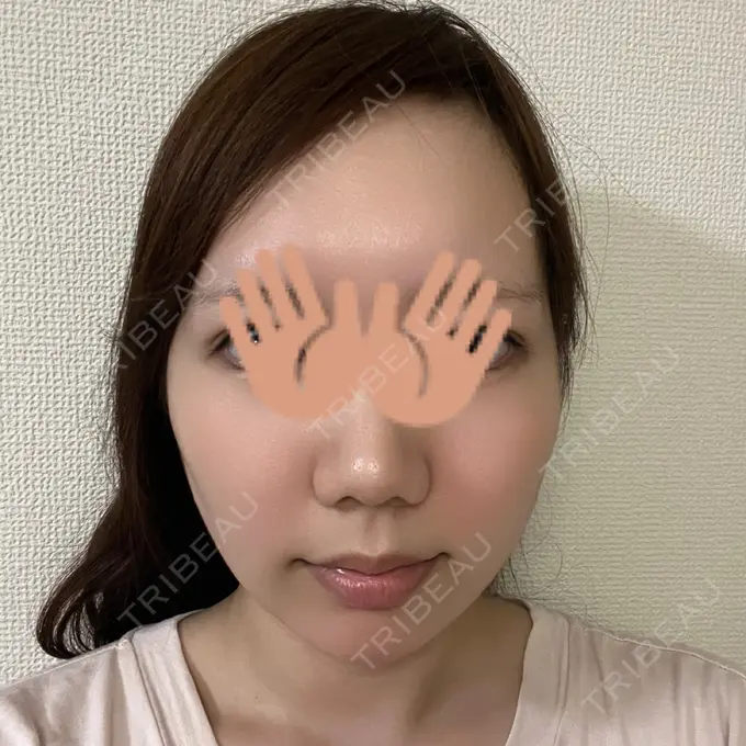 あごプロテーゼ WOM CLINIC GINZA （ワム クリニック ギンザ） DAY 63 メイン用