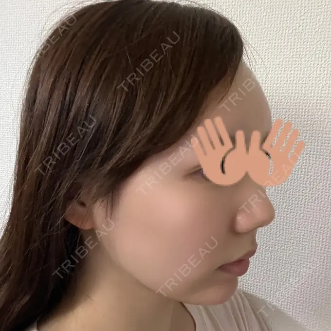 あごプロテーゼ WOM CLINIC GINZA （ワム クリニック ギンザ） DAY 63 メイン用