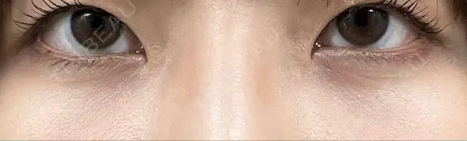 クマ治療 / 下まぶたの脂肪取り 吉井クリニック AFTER メイン用