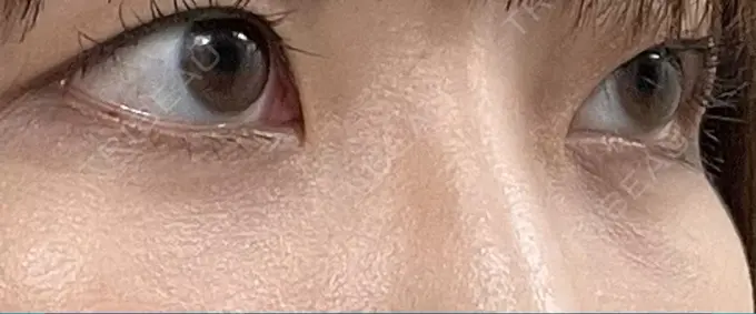 クマ治療 / 下まぶたの脂肪取り 吉井クリニック DAY 13 メイン用