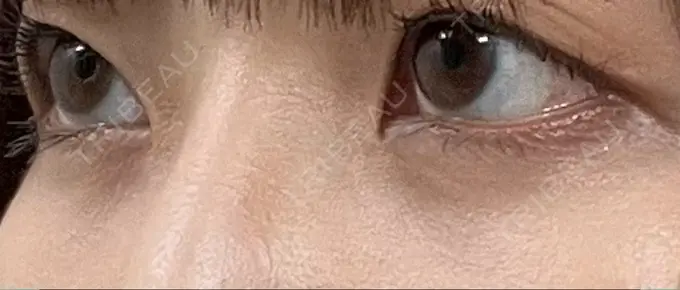 クマ治療 / 下まぶたの脂肪取り 吉井クリニック DAY 13 メイン用