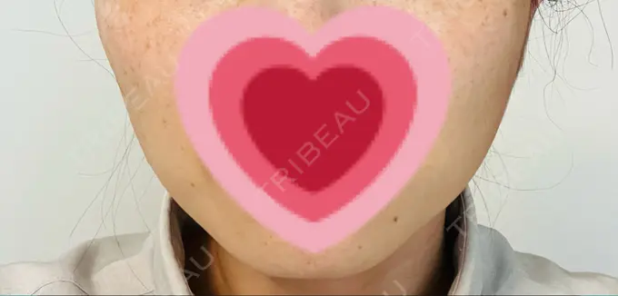 ボトックス（エラ・小顔） TCB東京中央美容外科 仙台駅前院 DAY 13 メイン用