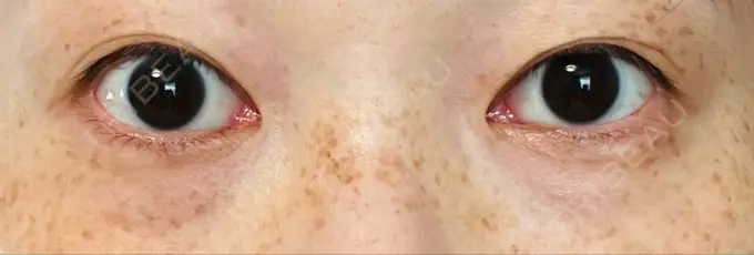 スネコス TCB東京中央美容外科 仙台駅前院 DAY 13 メイン用