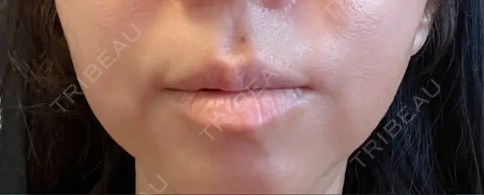 ボトックス（人中） しらゆりメディカルクリニック （旧しらゆりビューティークリニック） AFTER メイン用