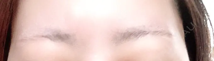 医療脱毛（顔） Jスキンクリニック 【J-SKIN clinic】 DAY 7 メイン用