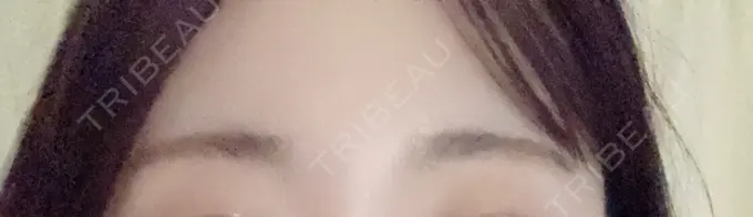 医療脱毛（顔） Jスキンクリニック 【J-SKIN clinic】 AFTER メイン用