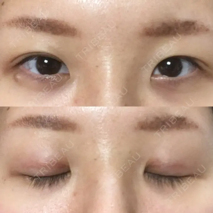 眼瞼下垂（切開） みずほクリニック DAY 64 メイン用