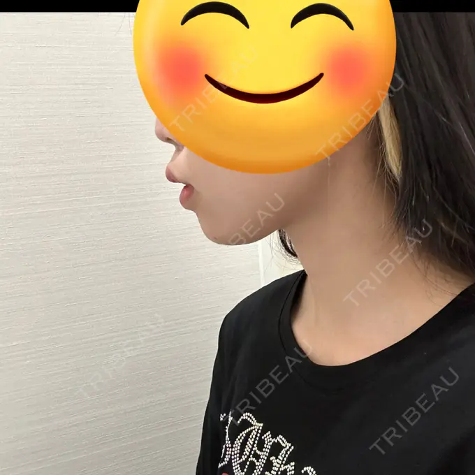 あごプロテーゼ / その他（輪郭） WOM CLINIC GINZA （ワム クリニック ギンザ） AFTER メイン用