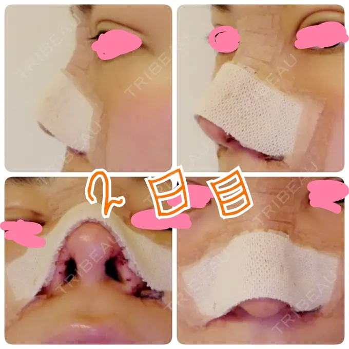 隆鼻術 / 鼻尖形成（切開） / 鼻尖縮小 ヤスミクリニック DAY 2 メイン用