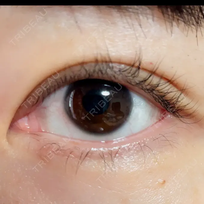 二重埋没 よだ形成外科クリニック AFTER メイン用