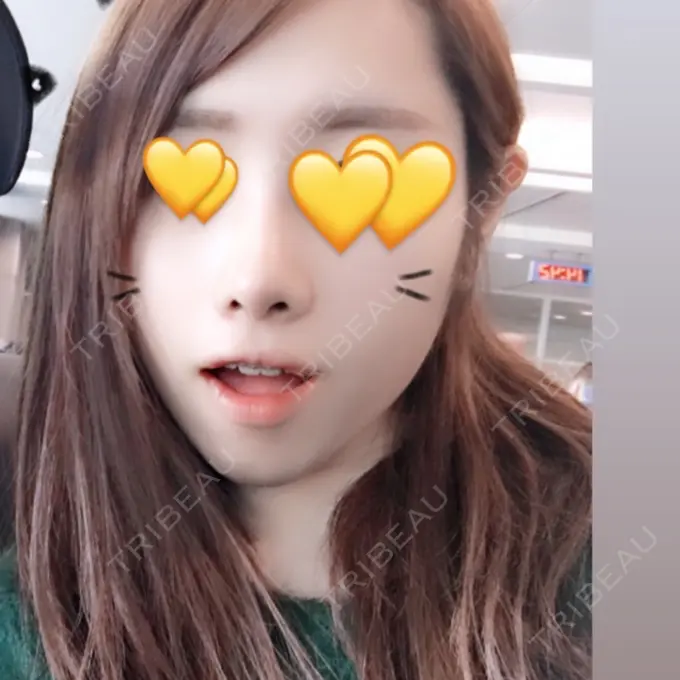 小鼻縮小（切開） / その他（鼻） FROM B整形外科 (旧バウム整形外科) DAY 9 メイン用