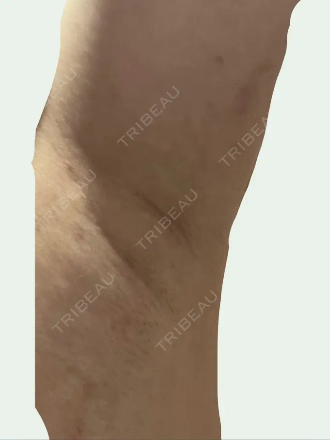 ワキ汗治療（レーザー） エースクリニック 名古屋院 DAY 2 メイン用