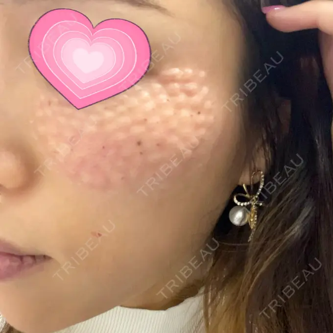 リジュラン ルラ美容クリニック 渋谷本院 DAY 1 メイン用