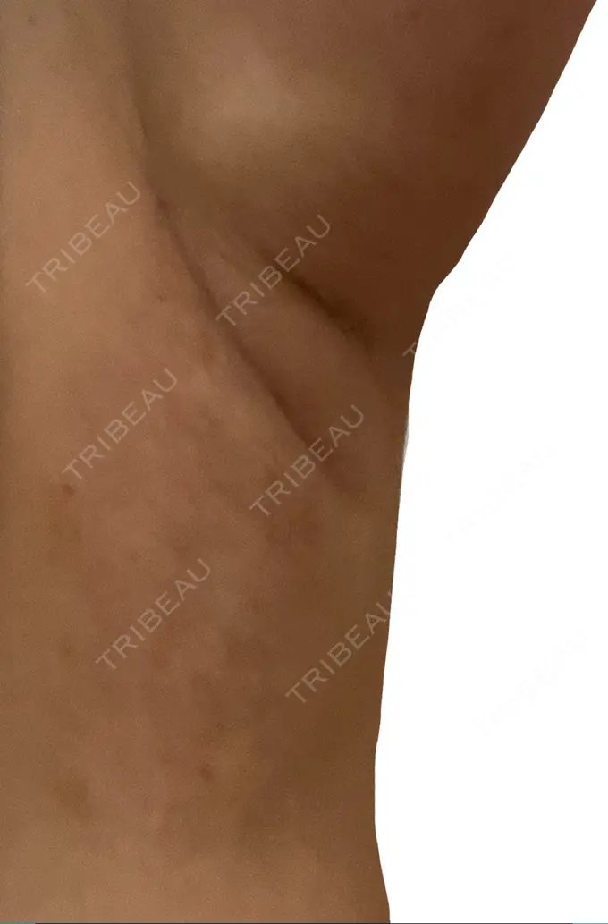 ワキ汗治療（レーザー） エースクリニック 名古屋院 DAY 3 メイン用