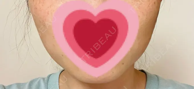 ボトックス（エラ・小顔） TCB東京中央美容外科 仙台駅前院 AFTER メイン用