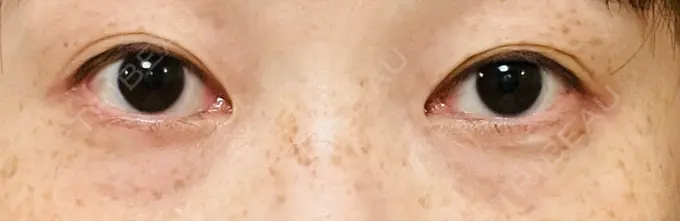 スネコス TCB東京中央美容外科 仙台駅前院 AFTER メイン用