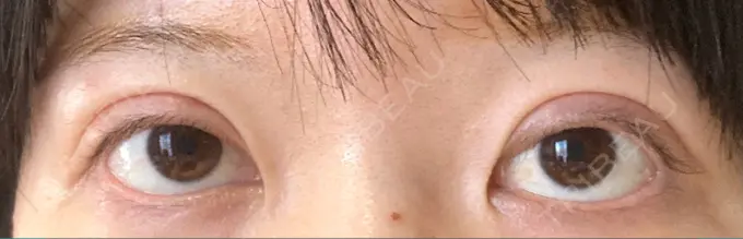 二重切開 / 目元修正 心斎橋コムロ美容外科クリニック DAY 247 メイン用